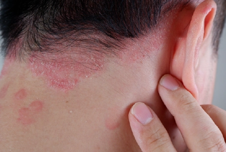 Psoriasis-Treatment