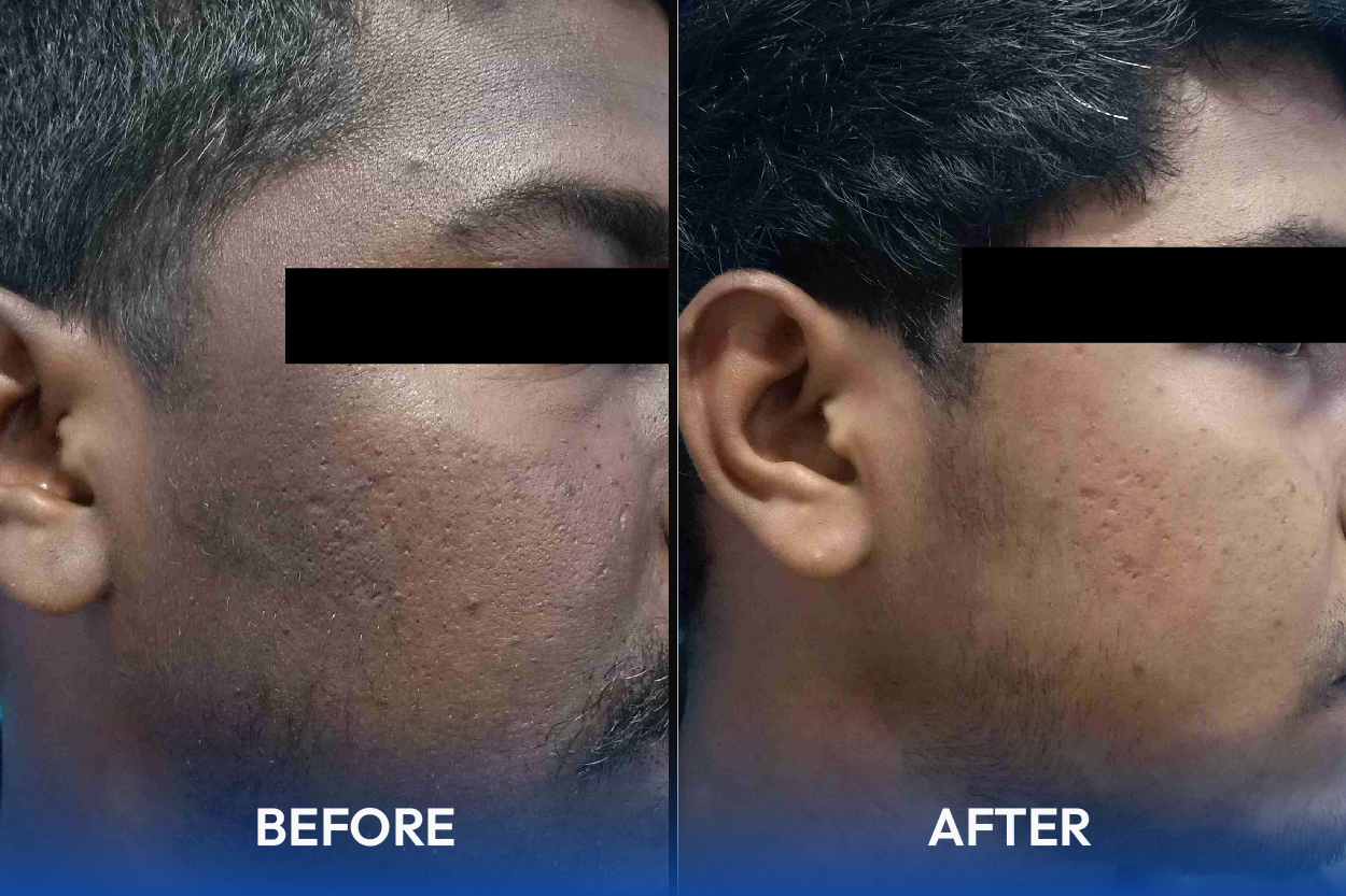 Laser Hair Removal Treatment