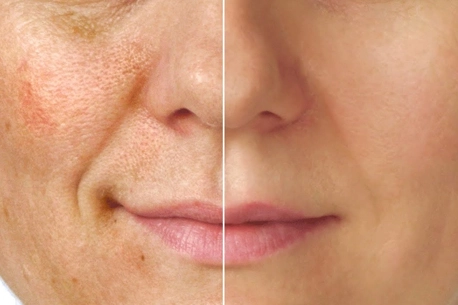 pigmentation-treatment