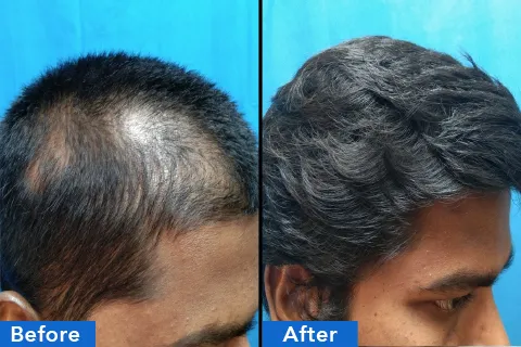 Hair treatments chennai