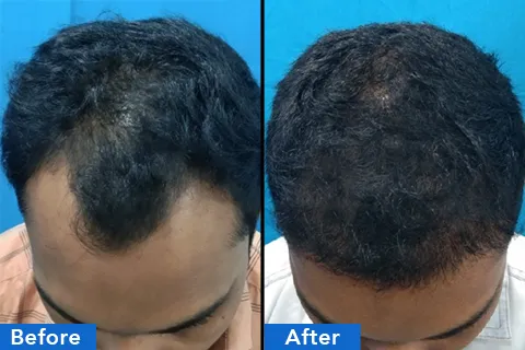 Hair treatments chennai