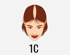 Hair transplant treatment