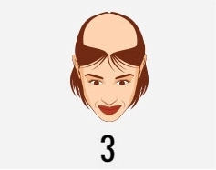 Hair transplant treatment