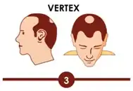 Hair transplant treatment