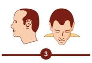 Hair transplant treatment