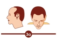 Hair transplant treatment