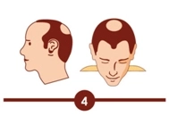 Hair transplant treatment