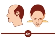 Hair transplant treatment