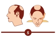 Hair transplant treatment