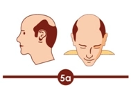Hair transplant treatment