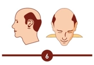 Hair transplant treatment