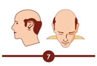 Hair transplant treatment