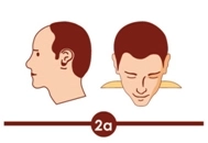 hair transplant treatment