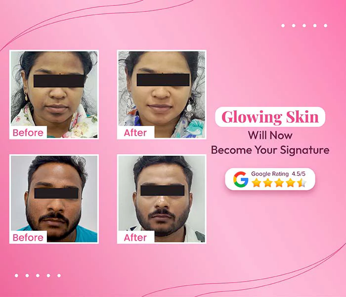 Hydrafacial Treatment