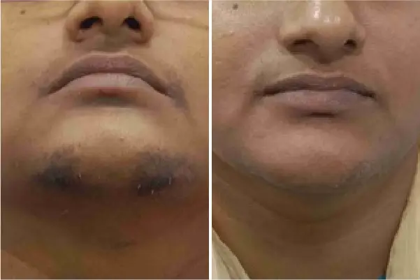 Laser Hair Removal Treatment