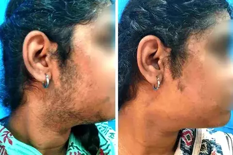 Laser Hair Removal Treatment