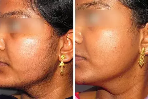 Laser Hair Removal Treatment
