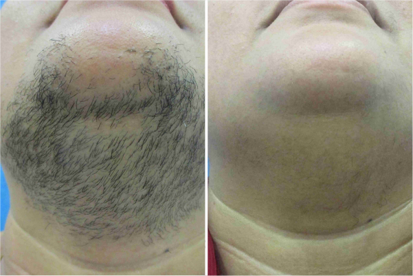 Laser Hair Removal Treatment