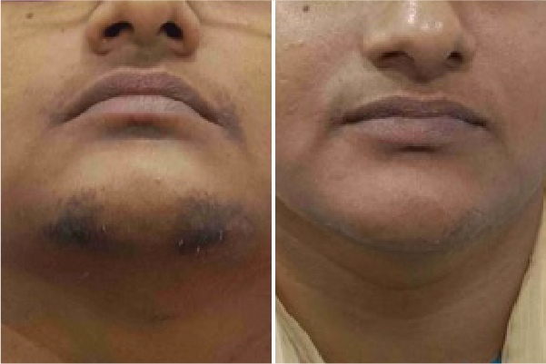 Laser Hair Removal Treatment