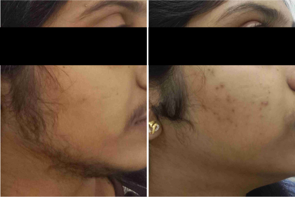 Laser Hair Removal Treatment