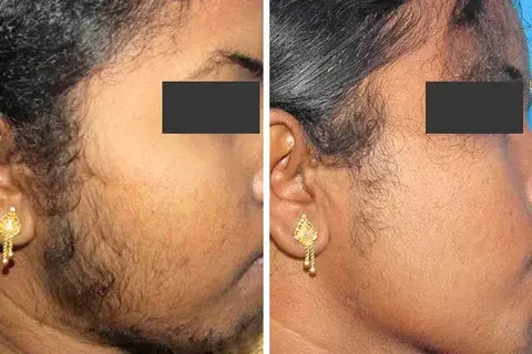 Laser Hair Removal Treatment