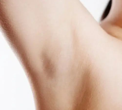 Laser Hair Removal Treatment