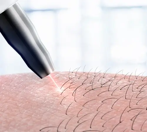 Laser Hair Removal Treatment