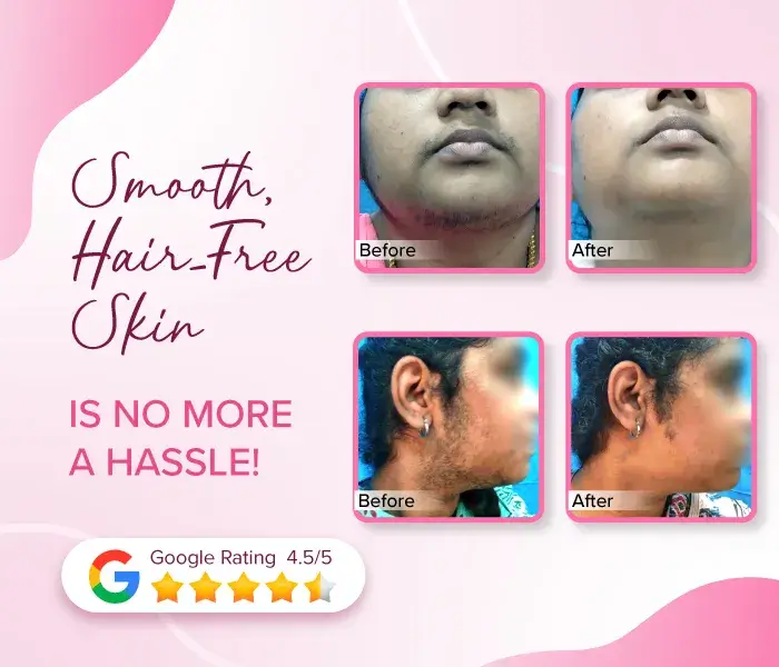Hair Removal - India's Safest Laser Hair Removal Clinic | VCare
