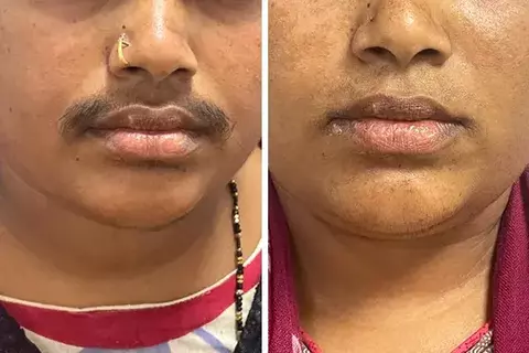 Laser Hair Removal Treatment