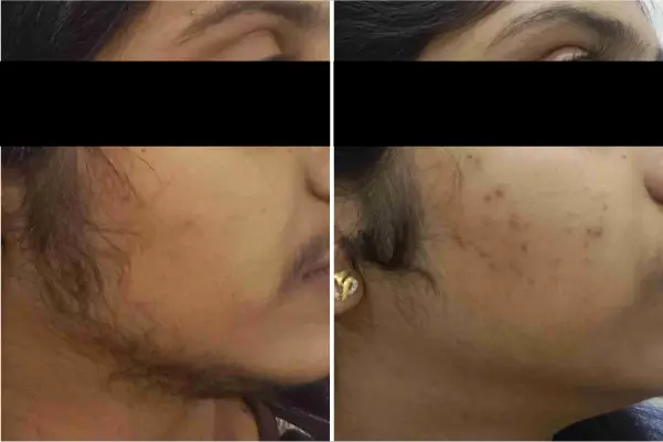 Laser Hair Removal Treatment