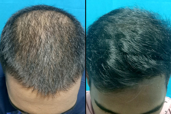 Best hair transplant clinic