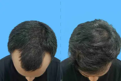 Hair Transplant