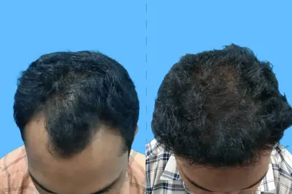 Hair Transplant