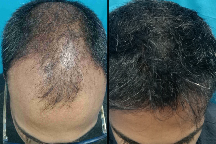 Hair Transplant