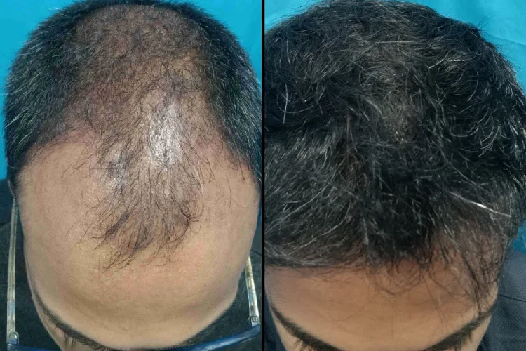 Hair Transplant Treatment