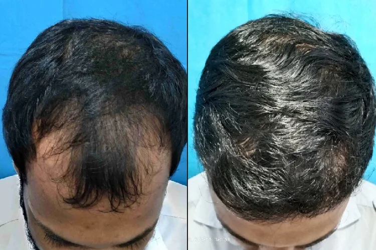 Hair Transplant Treatment