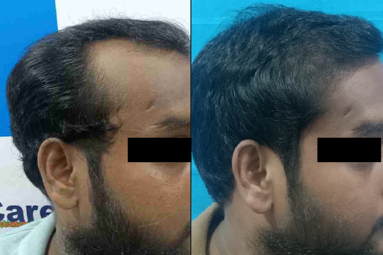 Hair Transplant