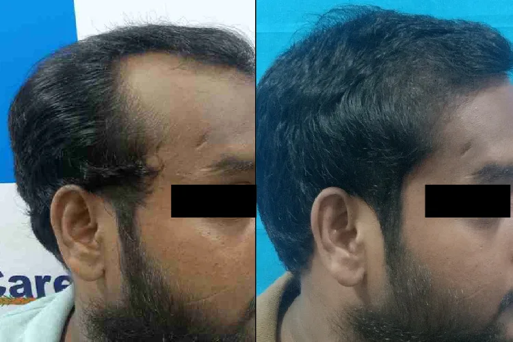 Hair Transplant Treatment