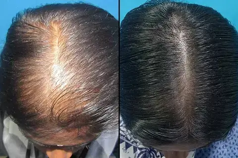 Hair Transplant Treatment