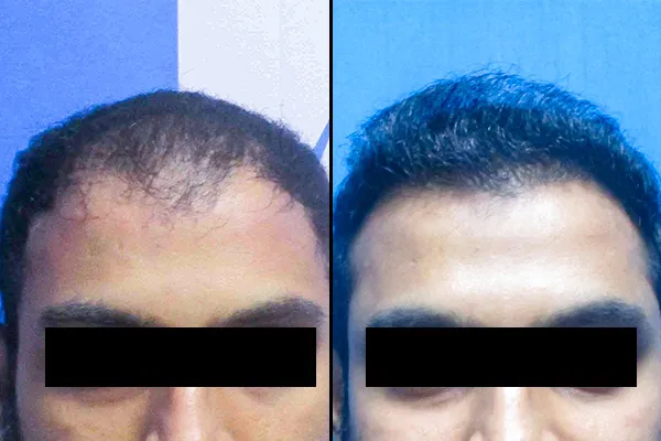 Hair Transplant Treatment