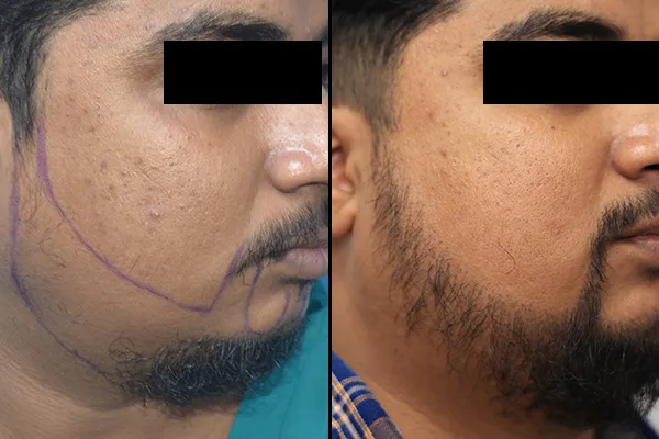Hair Transplant Treatment