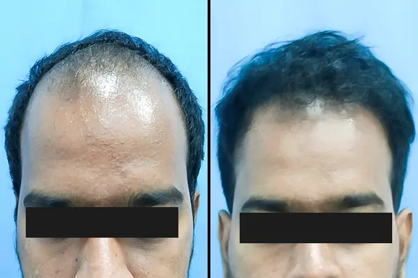 Hair Transplant Treatment