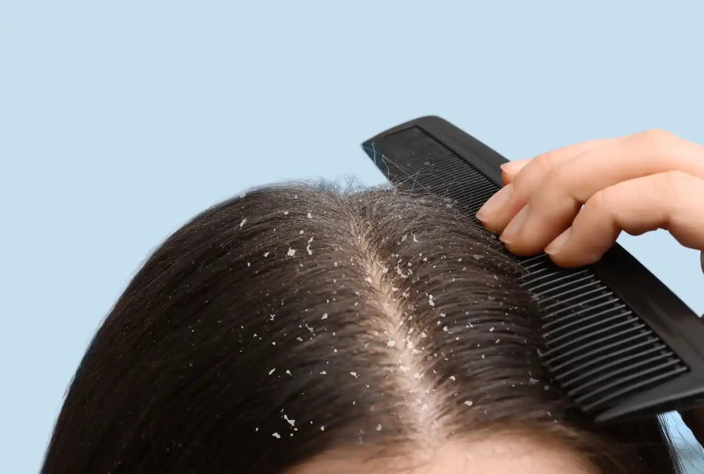 Dandruff