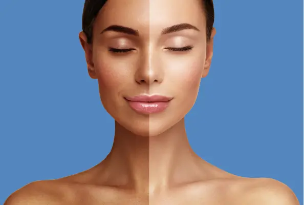 Alopecia-Areata