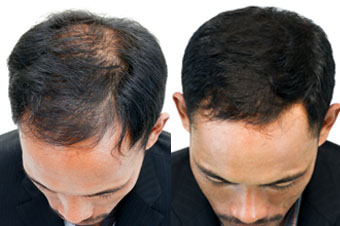 hair-replacement-in-vcare