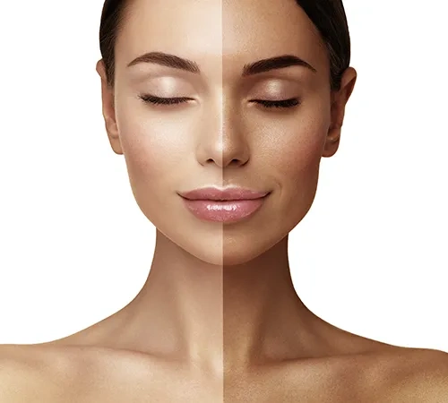 Laser Hair Removal Treatment