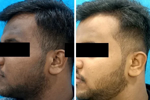 Laser Hair Removal Treatment