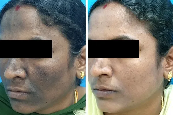 Laser Hair Removal Treatment