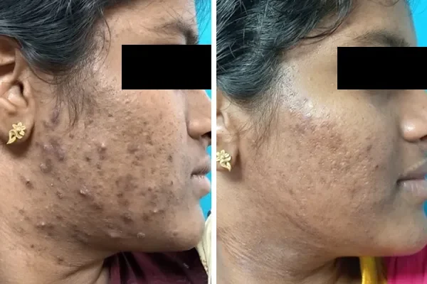 Laser Hair Removal Treatment