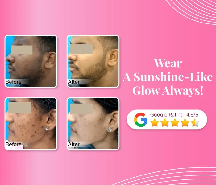 Skin Whitening - The best skin care clinic in India  VCare
